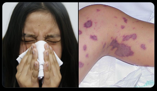 Minsa confirma brote de meningitis en Loreto | Servindi - Servicios de ...